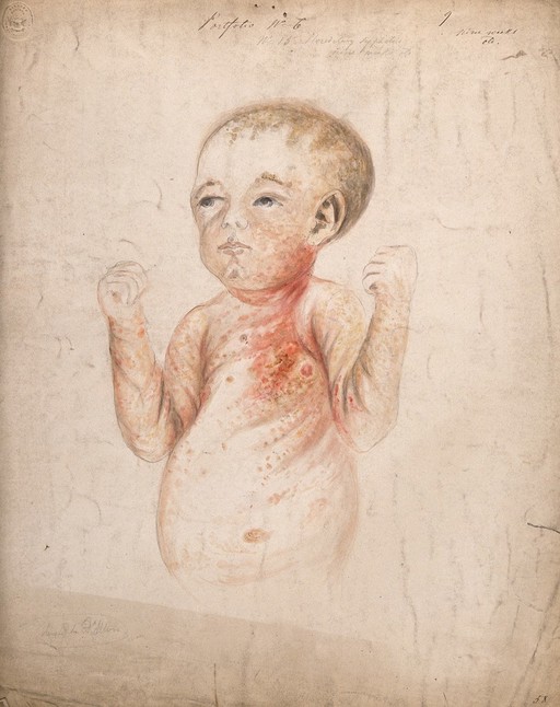 Syphilis; 9-week-old baby with hereditary syphilis, 1856