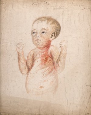 view A nine week old baby girl with diseased skin on her face, arms and body, displaying symptoms of hereditary syphilis. Watercolour by C. D'Alton, 1856.