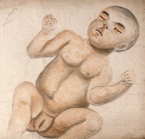 view A baby girl with infected eyes, from which pus is emanating. Watercolour by C. D'Alton, 1858.