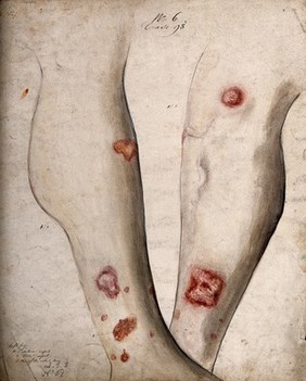 Sores and areas of diseased skin on the lower legs of a boy. Watercolour by C. D'Alton, 18--.