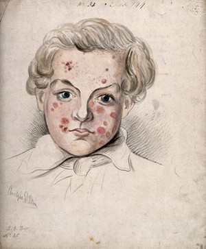 view Sores and areas of diseased skin on the face of a boy. Watercolour by C. D'Alton, 18--.