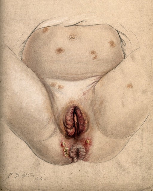 Hereditary syphilis; genital lesions in child, 1866
