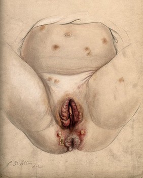 Severely diseased tissue and abcesses around the anus and genital area of a five year old girl suffering from hereditary syphilis, with sores also seen on the thighs and abdomen. Watercolour by C. D'Alton, 1866.