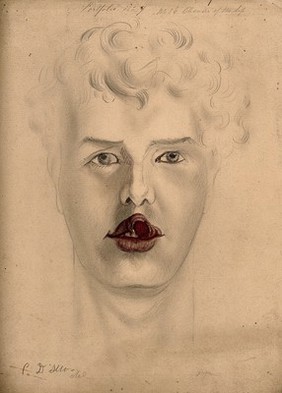 Face of a man suffering from chancre of the lip. Watercolour by C. D'Alton, 1867.