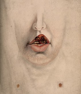 Chancre of the lip on the mouth of a man, with details showing sores. Watercolour by C. D'Alton, 18--.