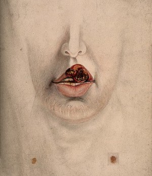 view Chancre of the lip on the mouth of a man, with details showing sores. Watercolour by C. D'Alton, 18--.