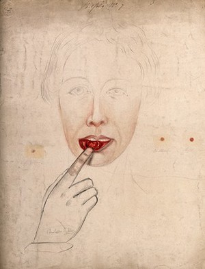 view A woman pointing to a sore or abcess inside her lower lip (possibly chancre of the lip), with details showing sores found on other parts of her body. Watercolour by C. D'Alton, 18--.