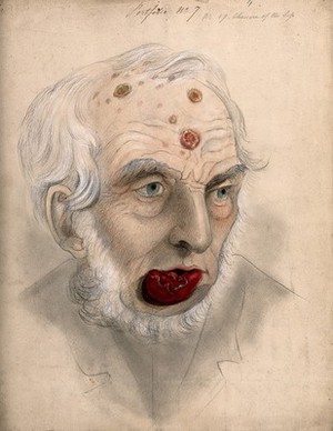 view A man suffering from chancre of the lip, displaying sores and abcesses on his scalp and forehead, with a swelling and diseased tissue inside his lower lip. Watercolour by C. D'Alton, 1867.