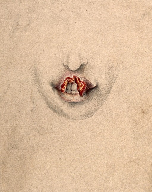 Syphilis; lesion on woman's upper lip, 1869
