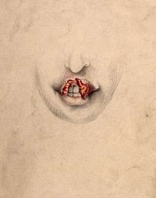 Severely diseased tissue on the upper lip of a woman suffering from tertiary syphilis. Watercolour by C. D'Alton, 1869.