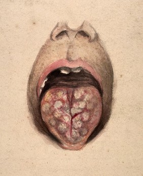 Diseased tissue on the tongue of a man suffering from syphilis. Watercolour by C. D'Alton, 18--.