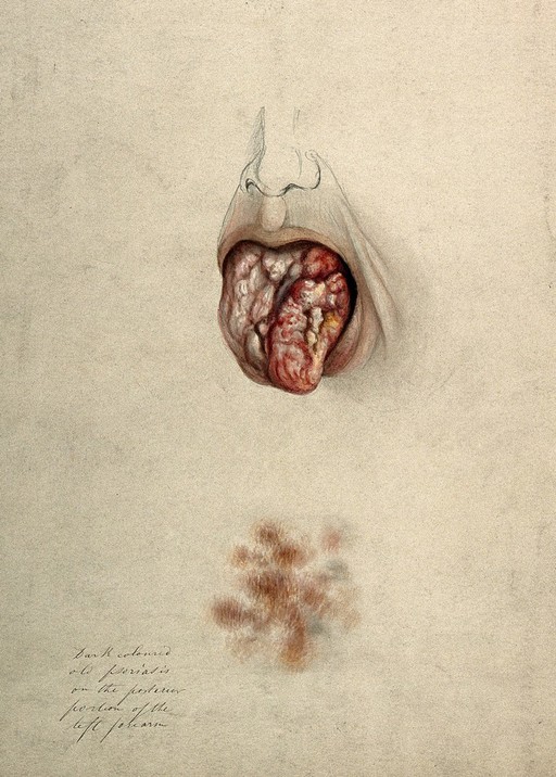 Syphilis; lesions on tongue; psoriatic lesion, 1865