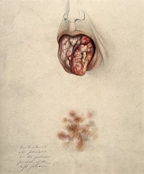 Diseased tissue on the tongue of a man suffering from syphilis, with a detail below showing an area of psoriasis on the man's arm. Watercolour by C. D'Alton, 1865.