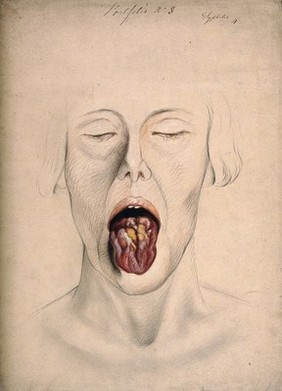 Diseased tissue on the tongue of a woman suffering from syphilis. Watercolour by C. D'Alton, 1866.