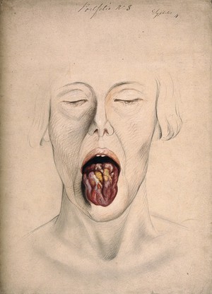 view Diseased tissue on the tongue of a woman suffering from syphilis. Watercolour by C. D'Alton, 1866.