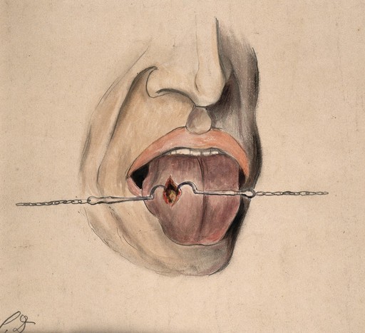 Syphilis; lesion on man's tongue, 1858