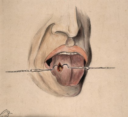 A diseased area of tissue on the tongue of a man suffering from syphilis, being held open by two small metal hooks on chains. Watercolour by C. D'Alton, 1858.