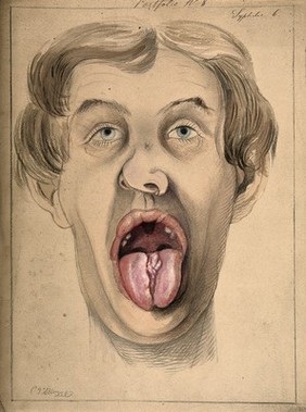 The face of a man suffering from syphilis, shown with mouth open wide, displaying areas of diseased tissue on the tongue and upper lip. Watercolour by C. D'Alton, 1869.