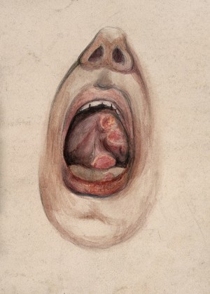 view The open mouth of a man suffering from syphilis, showing diseased tissue under the tongue (?). Watercolour by C. D'Alton, 1856.