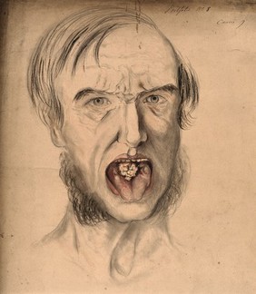 The face of a man with mouth open wide, displaying the symptoms of cancer, with an area of diseased tissue seen on the tongue. Watercolour by C. D'Alton, 1859.