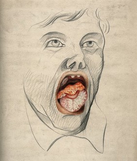 The face of a man with mouth open wide, displaying the symptoms of cancer of the tongue, with areas of severely diseased tissue seen on the tongue. Watercolour by C. D'Alton, 1865.