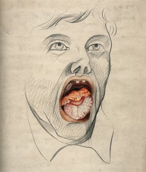 view The face of a man with mouth open wide, displaying the symptoms of cancer of the tongue, with areas of severely diseased tissue seen on the tongue. Watercolour by C. D'Alton, 1865.