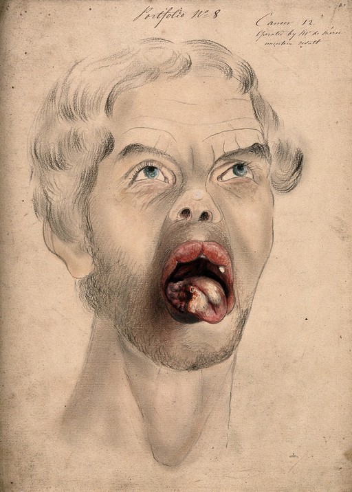 The face of a man suffering from cancer of the tongue, showing diseased tissue on the tongue. Watercolour by C. D'Alton, 1867.