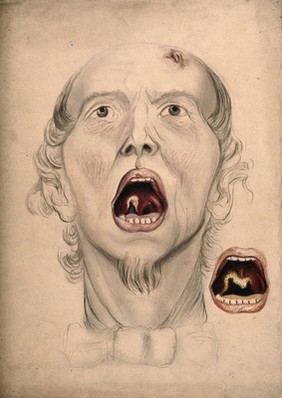 The face of a man, with mouth open wide, displaying a diseased area of tissue on the soft palate and uvula: includes a detail showing the progression of the disease in the mouth eleven days later. Watercolour by C. D'Alton, 1866.