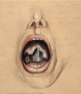 The open mouth of a man suffering from diseased tissue on the soft palate and uvula. Watercolour by C. D'Alton, 1866.