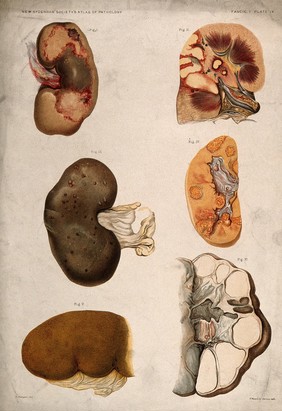 Dissections of diseased kidneys: six figures. Chromolithograph after E. Burgess, 1877.