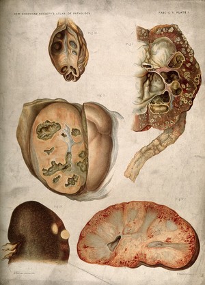 view Dissections of diseased kidneys: five figures. Chromolithograph by E. Burgess, 1877.