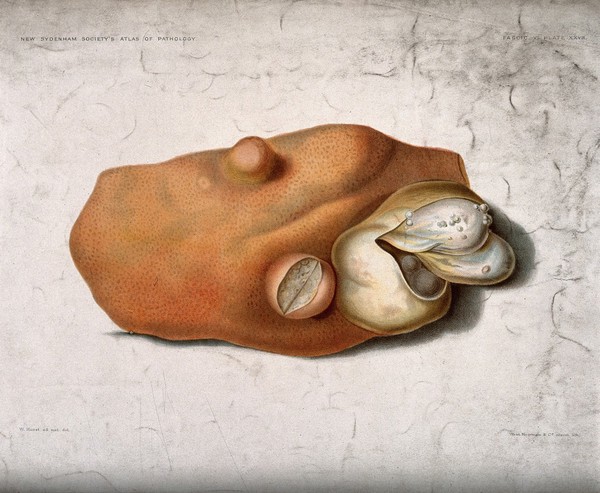 Part of a diseased liver containing several hyatid cysts. Chromolithograph by W. Hurst, ca. 1888.