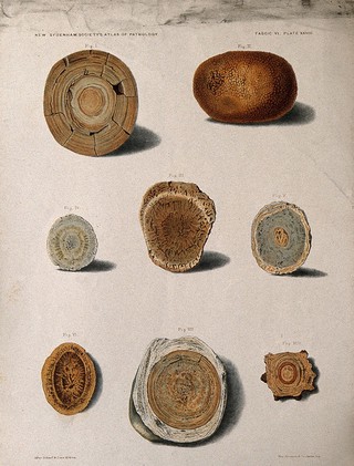 Calculi: eight examples, including uric acid calculi. Chromolithograph after Scharf and L. Aldous, ca. 1888.