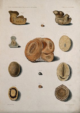 Calculi: twelve examples, including a uric acid calculus from the kidney. Chromolithograph after L. Aldous, ca. 1888.