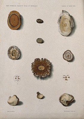 Calculi: twelve examples, including uric acid and lime calculi. Chromolithograph after L. Aldous, ca. 1888.