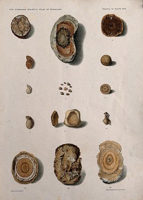 Urinary calculi: fourteen examples. Chromolithograph by West Newman & Co. after L. Aldous, ca. 1888.