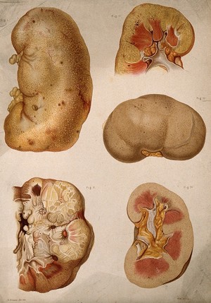 view Urinary calculi: fourteen examples. Chromolithograph by West Newman & Co. after L. Aldous, ca. 1888.