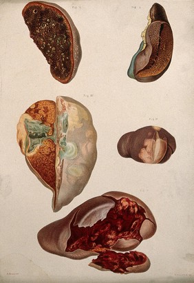 Diseased organs: five examples. Chromolithograph by E. Burgess, 1877/1899?.