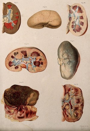 view Diseased kidneys: seven examples. Chromolithograph, 1877/1899?.