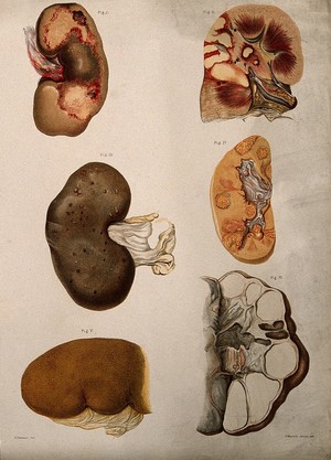 view Diseased kidneys: six examples. Chromolithograph by E. Burgess, 1877/1899?.