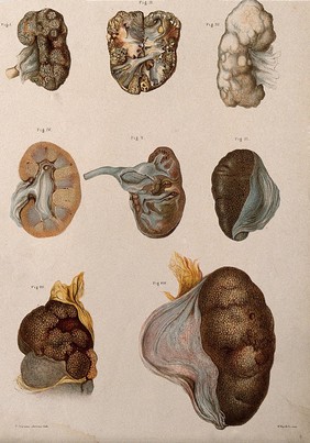 Diseased organs (kidneys?): eight examples. Chromolithograph by E. Burgess, 1877/1899?.