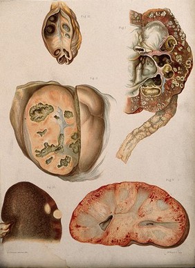 Diseased organs: five examples. Chromolithograph by E. Burgess, 1877/1899?.