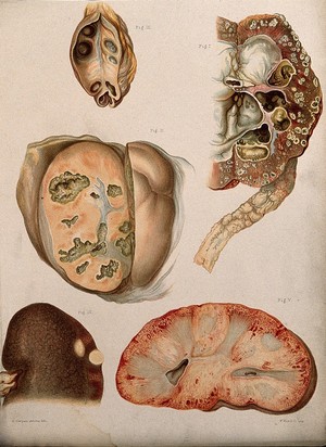 view Diseased organs: five examples. Chromolithograph by E. Burgess, 1877/1899?.