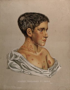 Areas of diseased skin on the face, neck, chest and arm of a boy suffering from herpes tonsurans. Chromolithograph by E. Burgess (?), 1850/1880?.