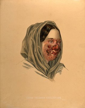 Diseased skin on the face of a woman suffering from lupus vulgaris. Chromolithograph by E. Burgess (?), 1850/1880?.