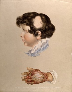 Area of baldness on the head of a boy suffering from alopecia areata, with the diseased hand of a sufferer of lupus shown below. Chromolithograph by E. Burgess (?), 1850/1880?.