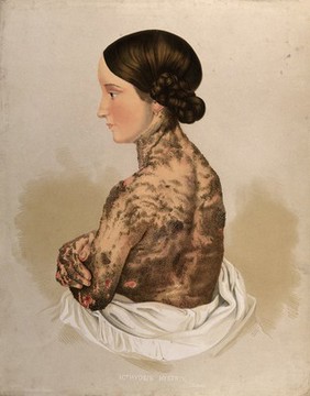 Diseased skin on the neck, back, arms and hands of a young woman suffering from icthyosis hystrix. Chromolithograph by E. Burgess (?), 1850/1880?.