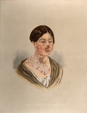 Diseased skin on the face, neck and chest of a young woman suffering from lupus. Chromolithograph by E. Burgess (?), 1850/1880?.