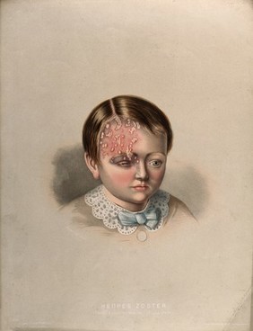 Diseased skin on the face and eye of a small boy suffering from herpes zoster (common shingles). Chromolithograph by E. Burgess (?), 1850/1880?.