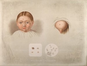 view Diseased skin on the face of a girl suffering from molluscum contagiosum, shown beside a diseased breast, with two details below showing sebaceous follicles and cells as seen under a microscope. Chromolithograph by E. Burgess (?), 1850/1880?.